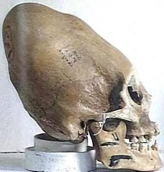 conehead-skull